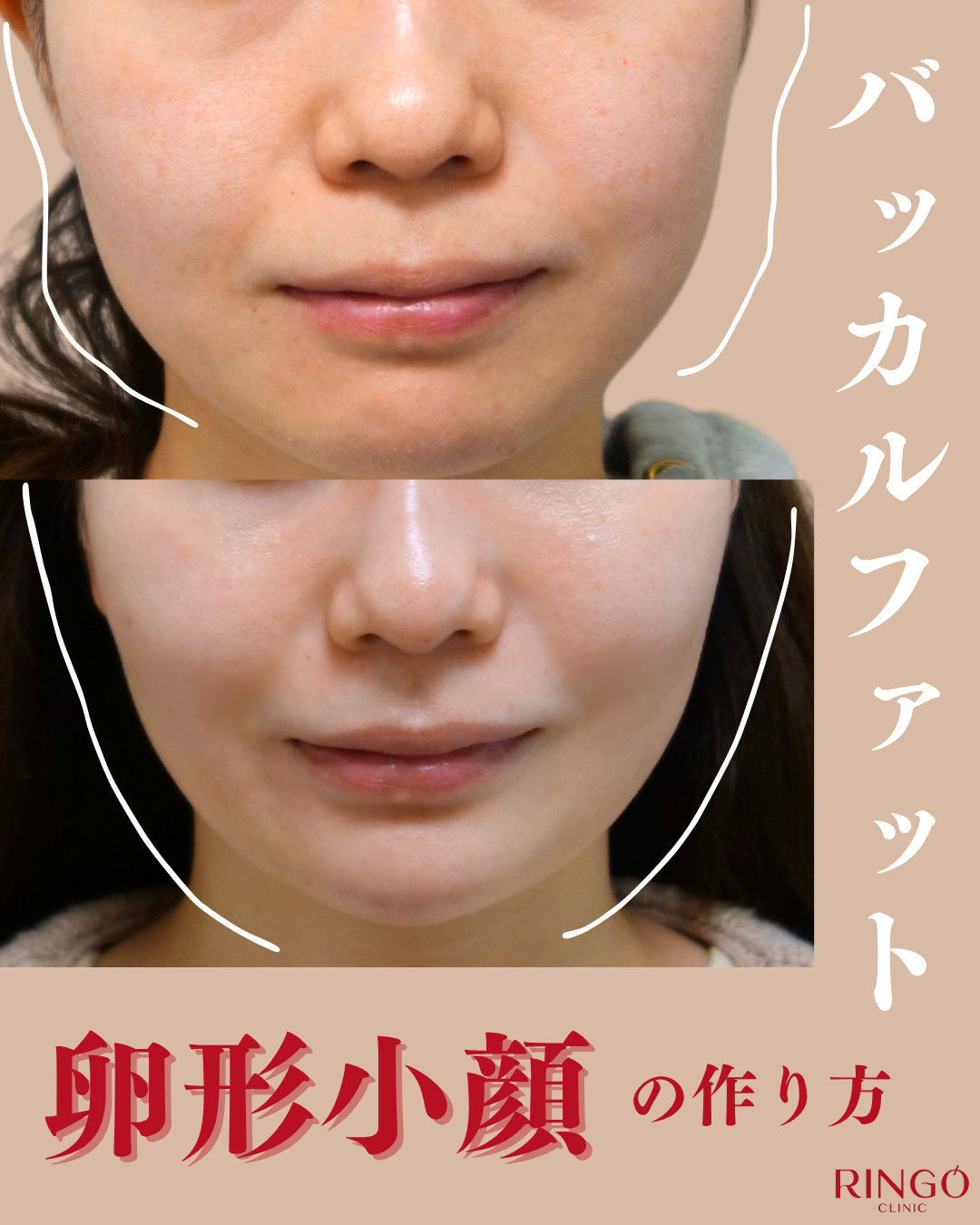 バッカルファット除去 下膨れ解消 脂肪吸引 小顔治療 ビフォーアフター