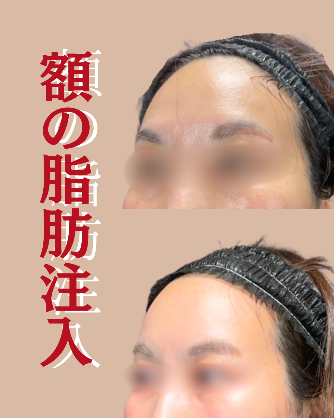 顔 額 こめかみ 脂肪注入 ビフォーアフター