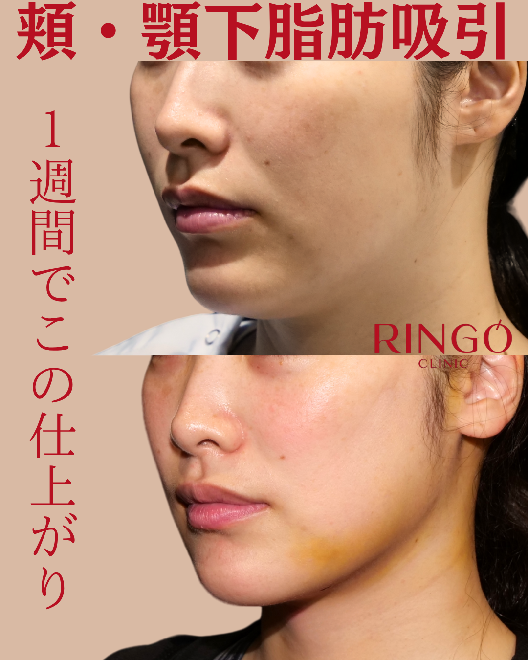顔 頬 顎下 フェイスライン 脂肪吸引 ビフォーアフター ダウンタイム