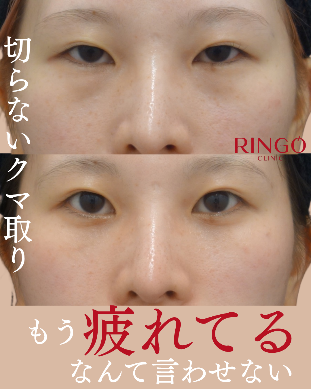 クマ取り ビフォーアフター 症例写真