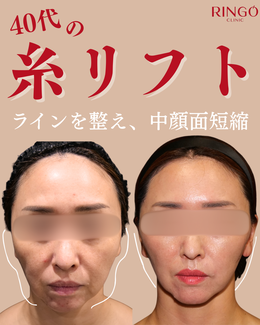 糸リフト ビフォーアフター テスリフト