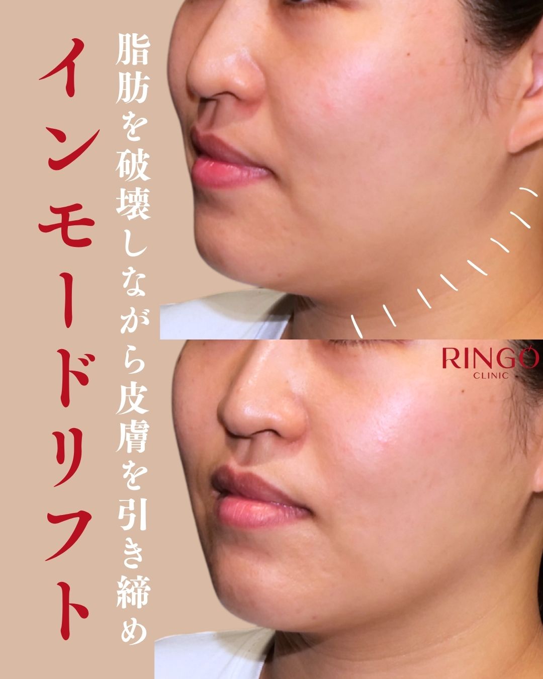 銀座で行うインモードリフトの症例写真|RINGO CLINIC