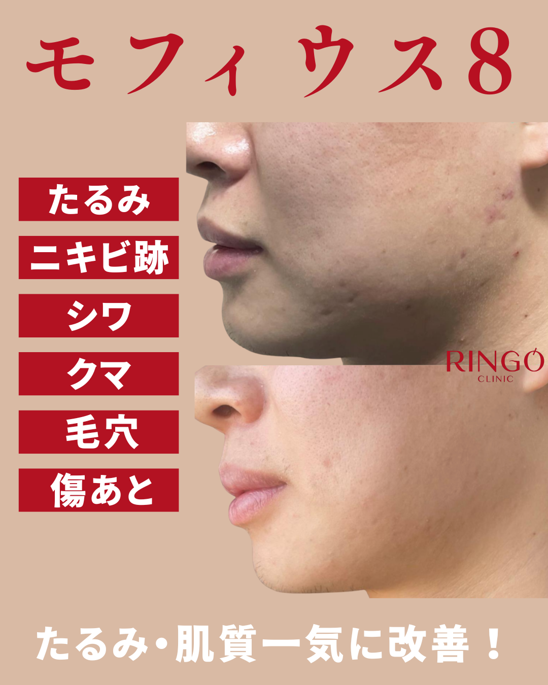 モフィウス8　ビフォーアフター　たるみ　肌質改善