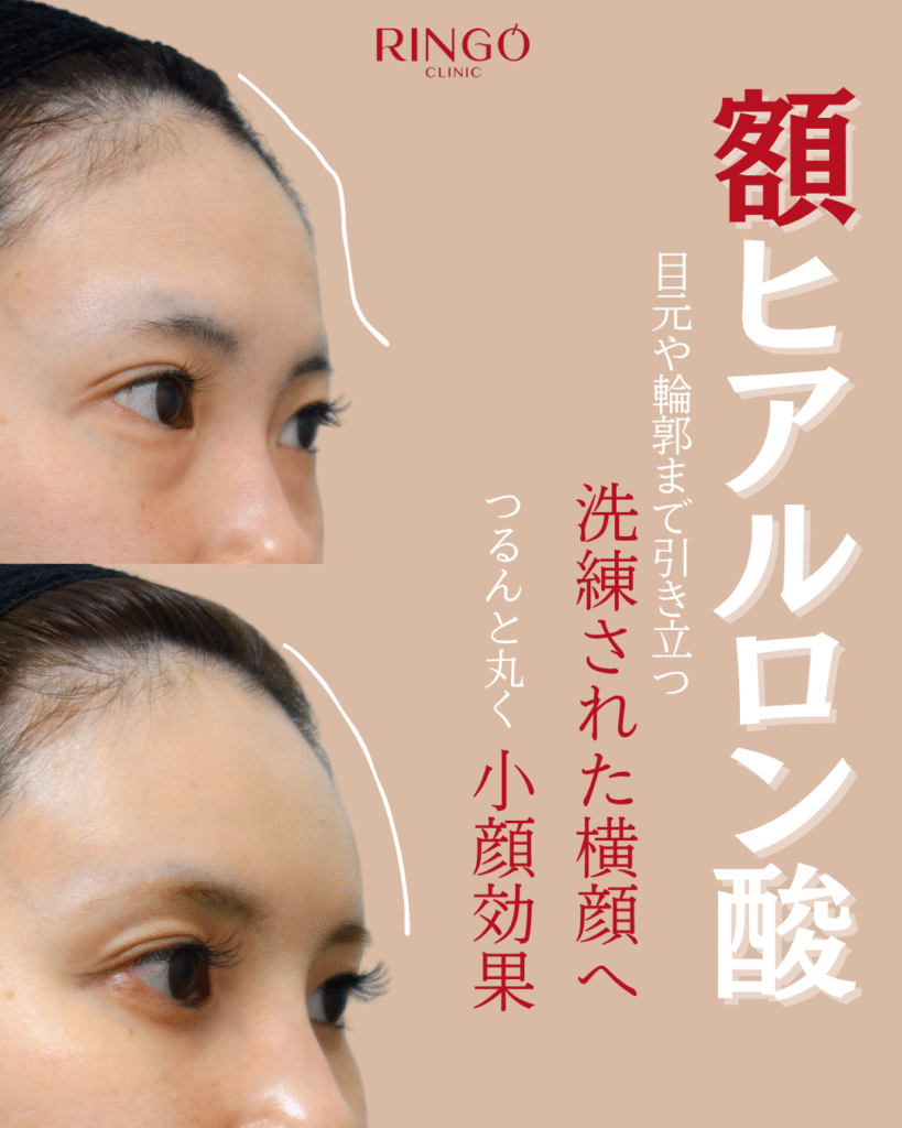 額ヒアルロン酸