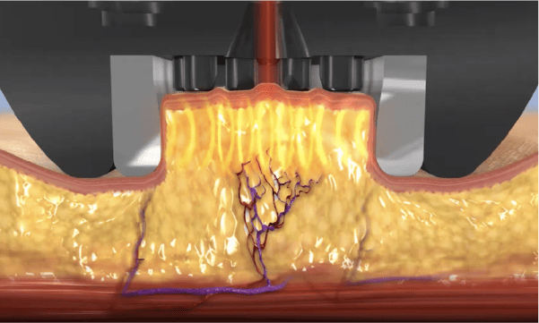 MiniFXのメカニズム