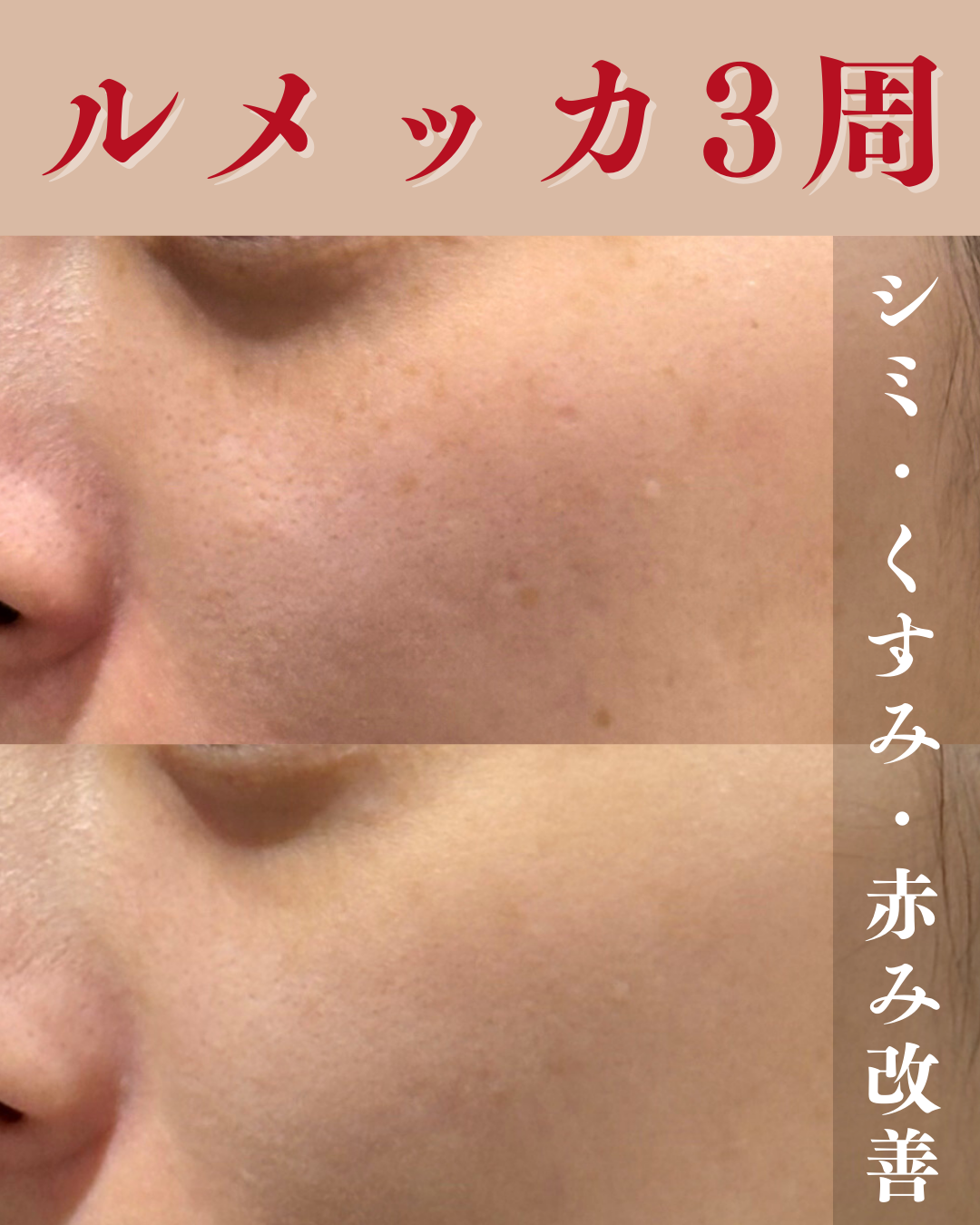 ルメッカがおすすめの方｜RINGO CLINIC