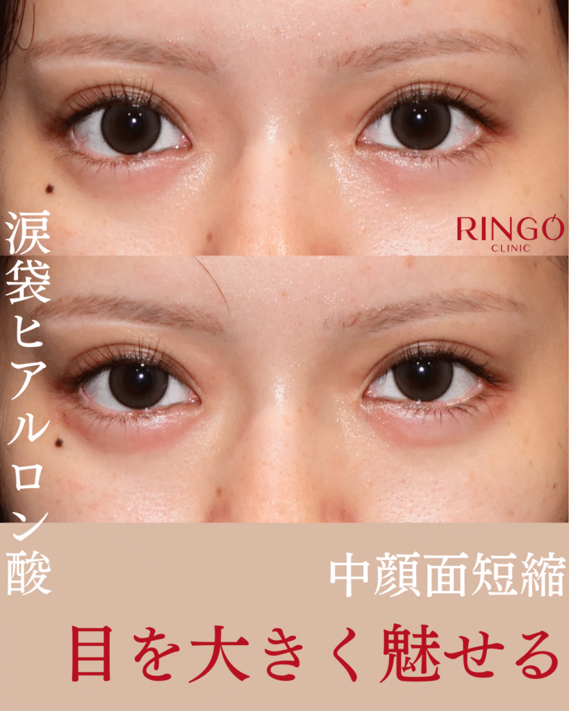 涙袋ヒアルロン酸　中顔面短縮