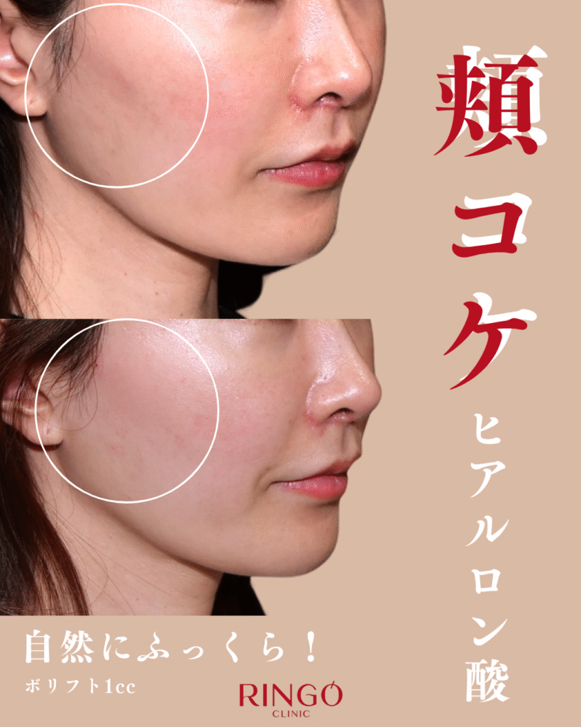 頬コケ　ヒアルロン酸