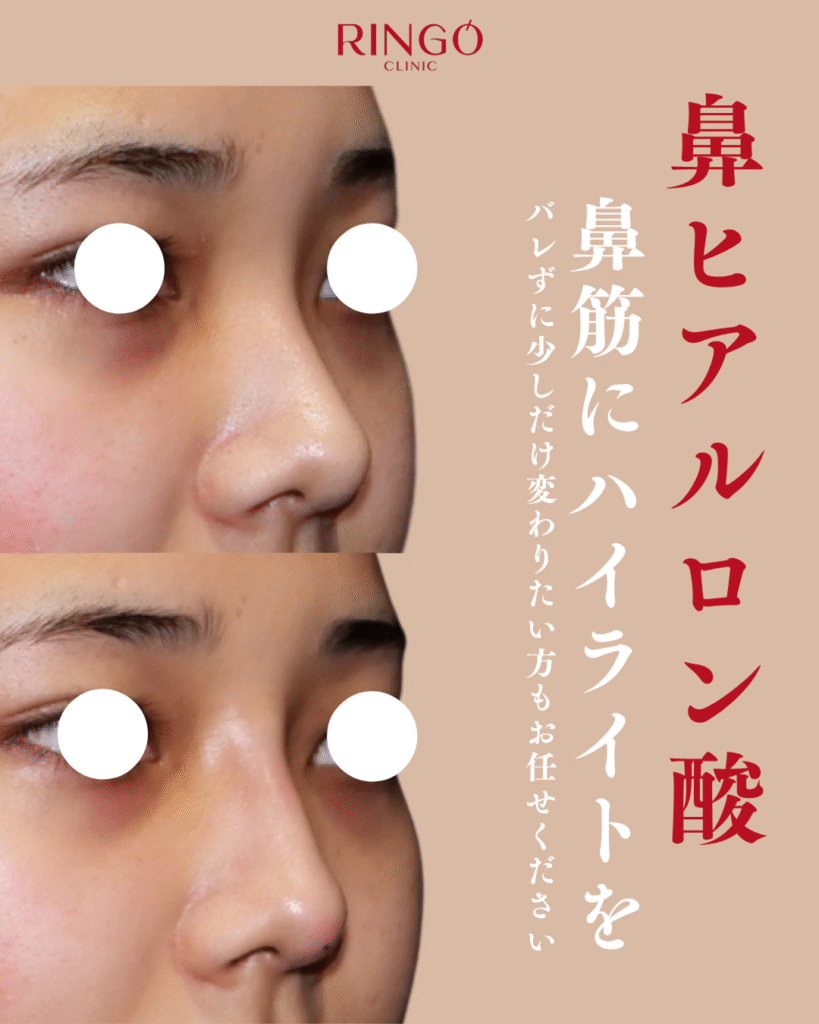 鼻ヒアルロン酸